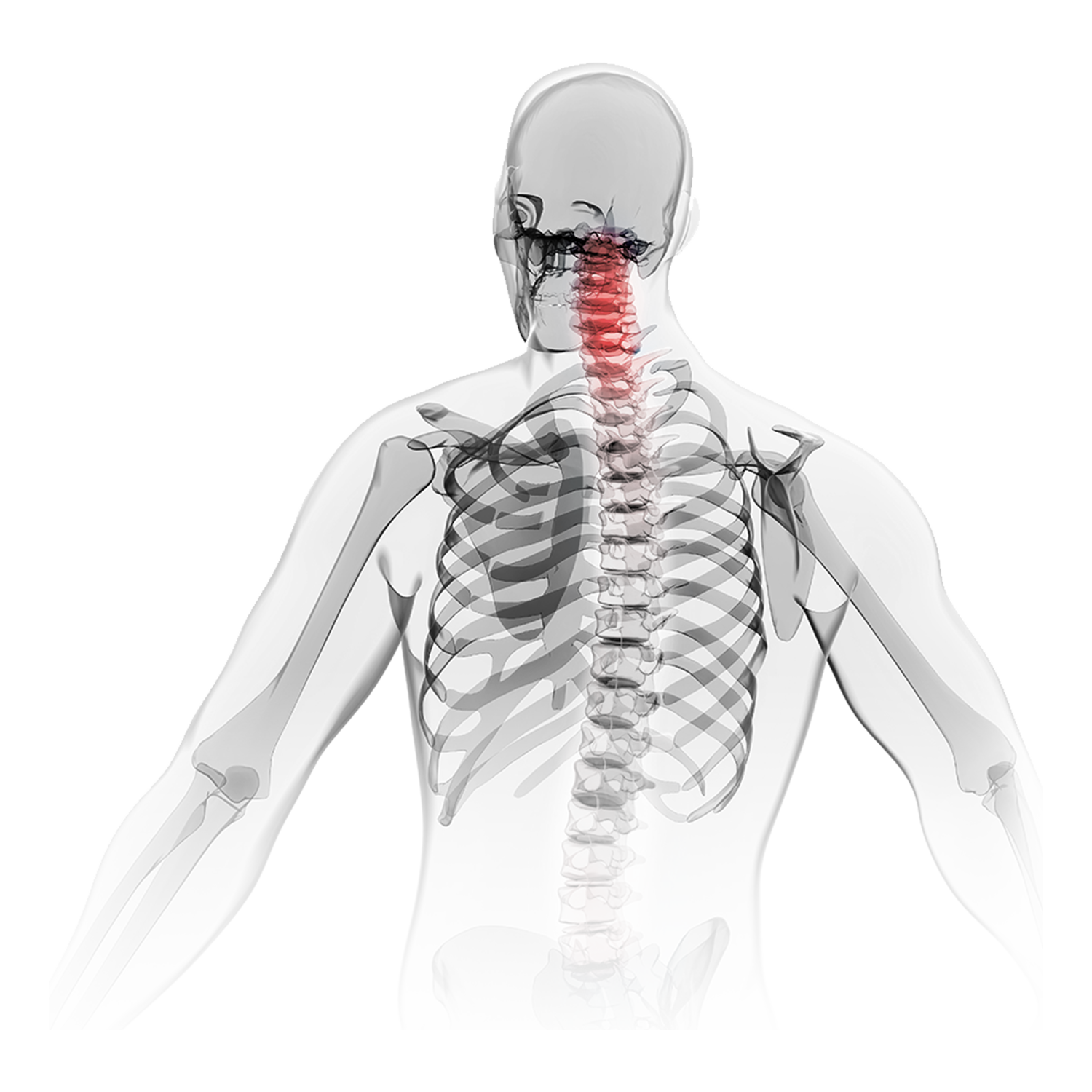 ACDF anterior cervical spine surgical solution