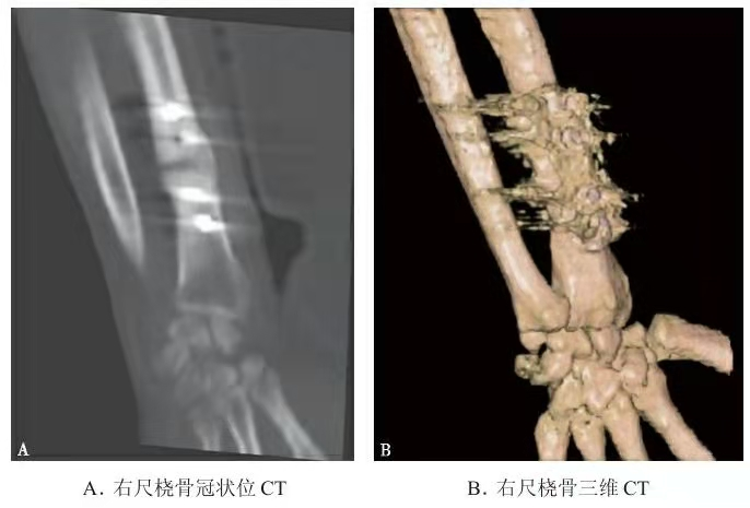 Imagen de TC representativa de una fractura de radio distal con artefacto de fijaci&oacute;n con placa