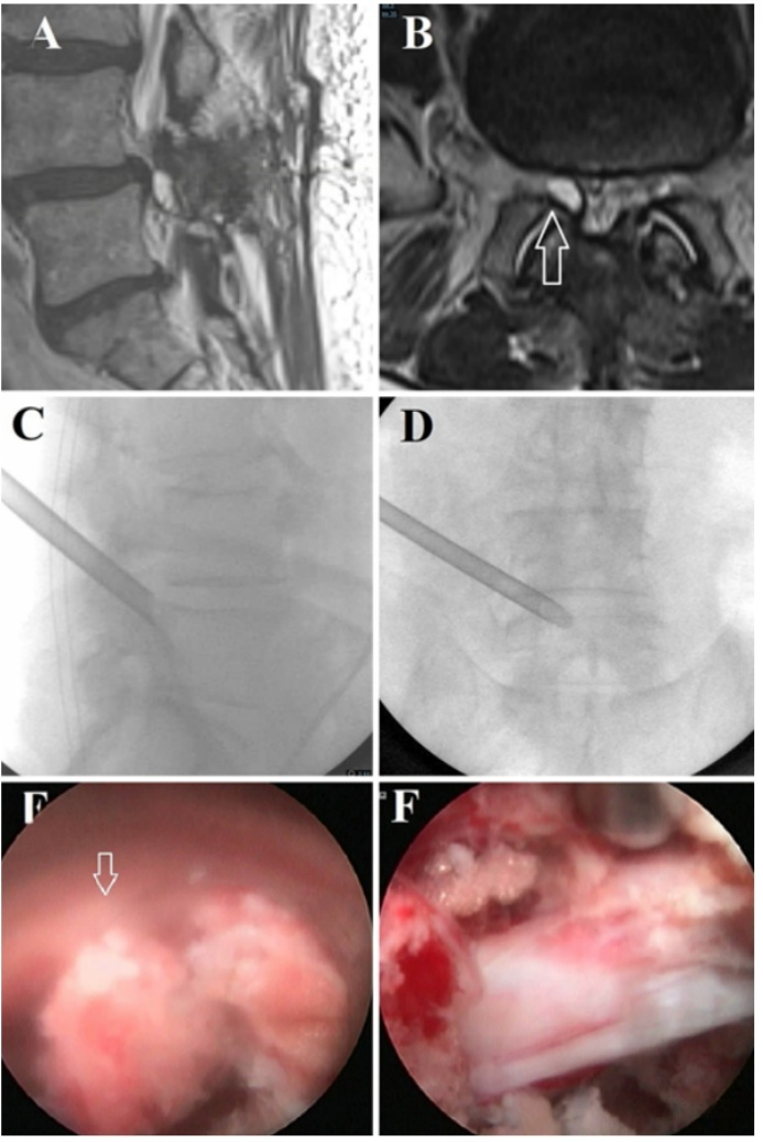 Fluoroscopia por resonancia magn&eacute;tica e im&aacute;genes endosc&oacute;picas de la descompresi&oacute;n del quiste de la articulaci&oacute;n facetaria lumbar