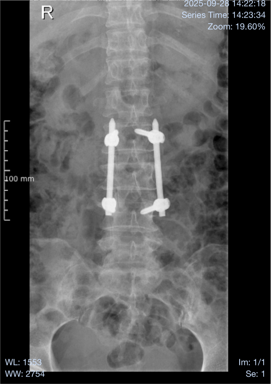 Radiograf&iacute;a que muestra el sistema de fijaci&oacute;n interna espinal XC Medico