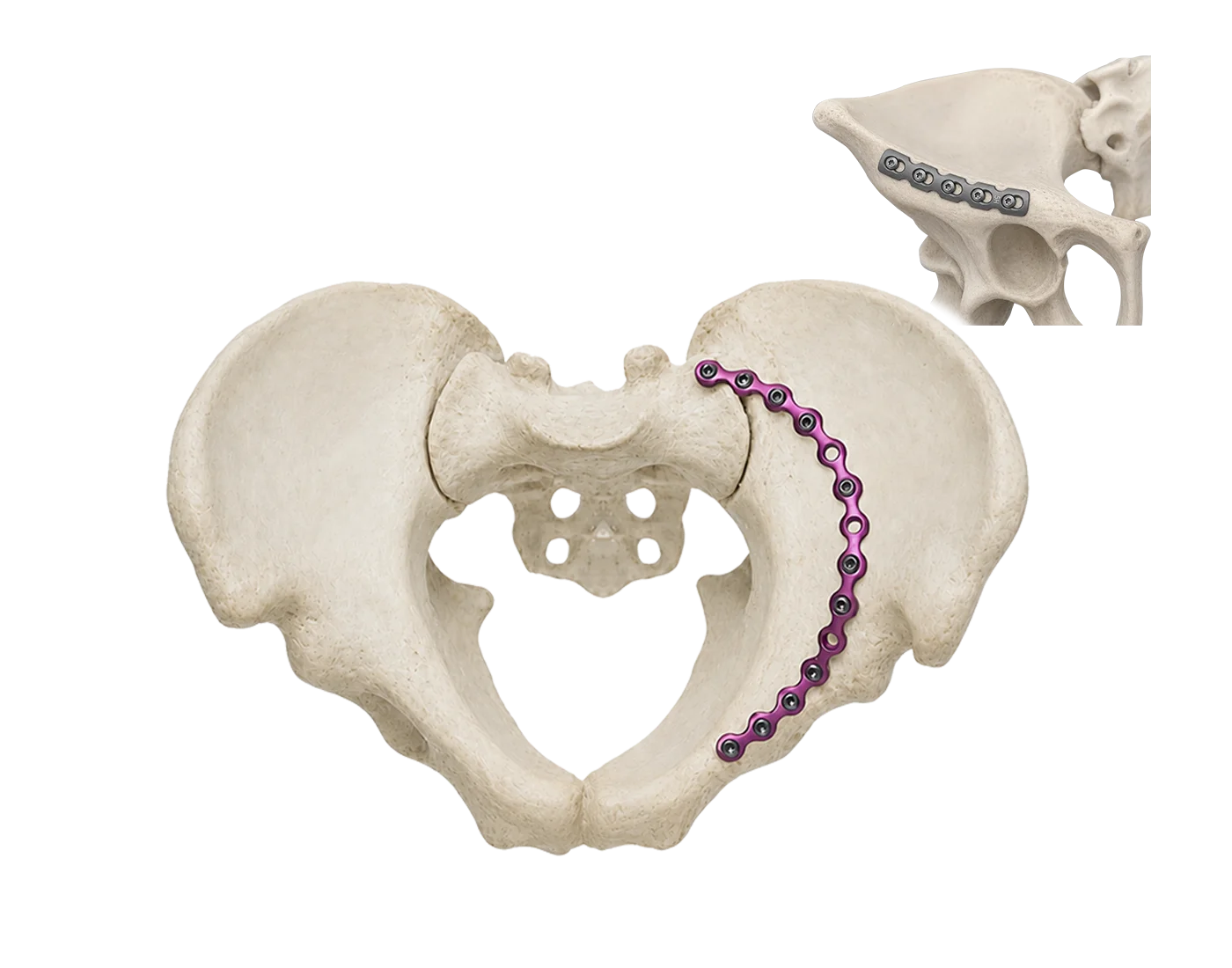 Pelvic ring anatomy with pelvic and reconstruction locking plate options