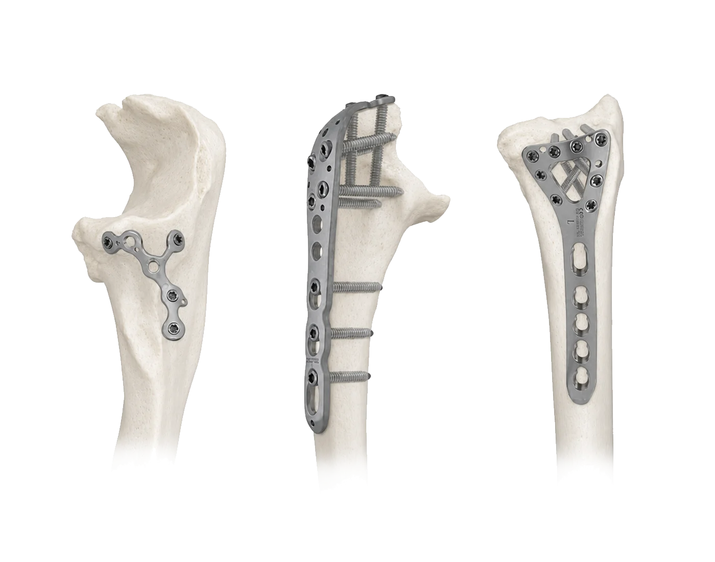 Olecranon and proximal ulna fracture fixation systems