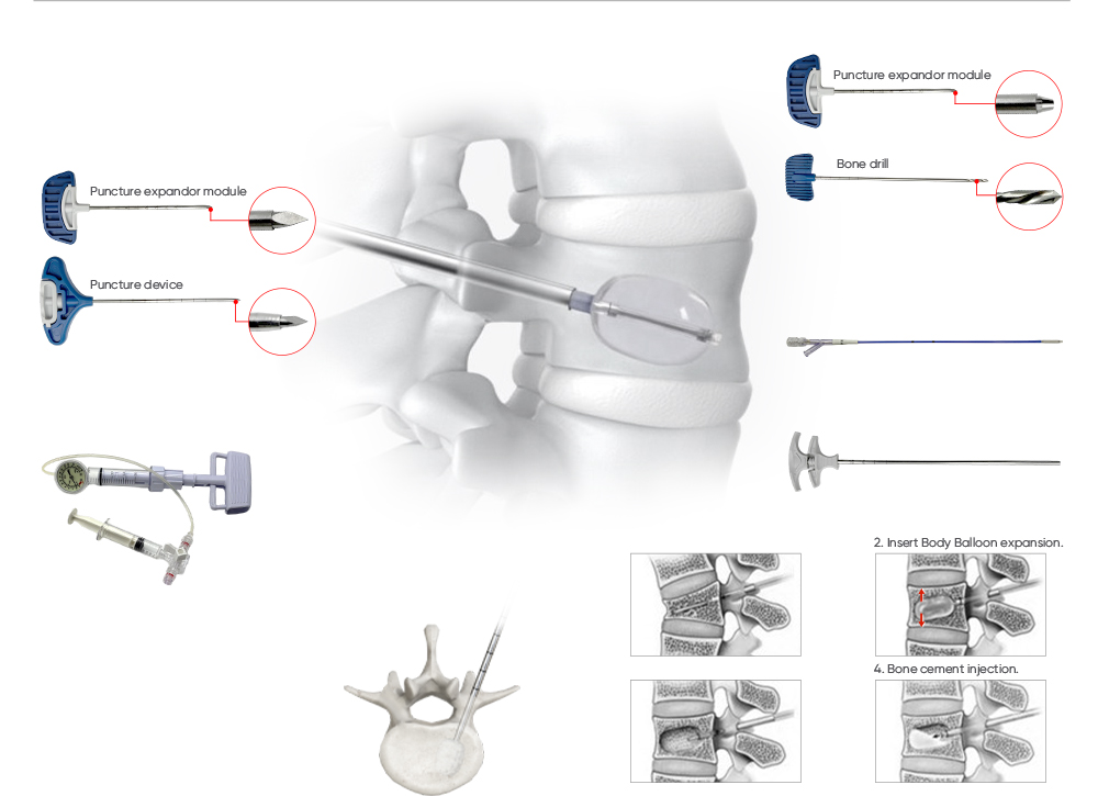 Aleaci&oacute;n de titanio premium y mecanizado CNC de alta precisi&oacute;n para instrumentos quir&uacute;rgicos de cifoplastia