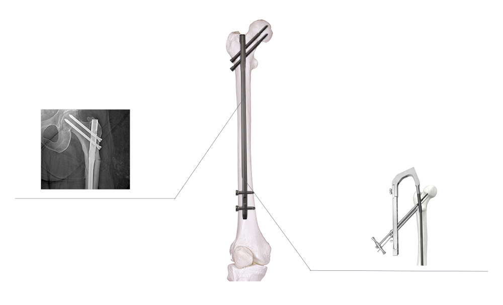 Din&aacute;mica de fijaci&oacute;n del clavo femoral y optimizaci&oacute;n proximal