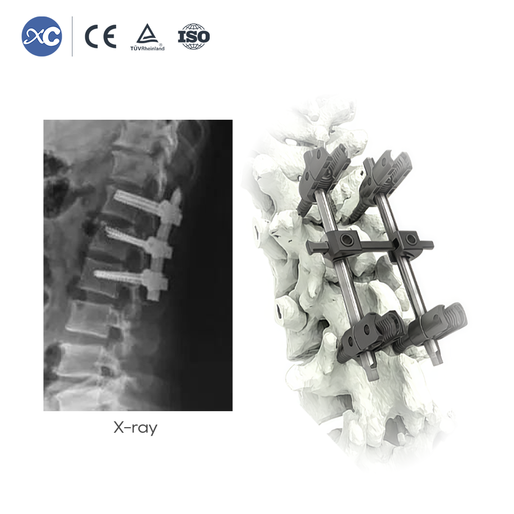 Sistema de tornillos pediculares poliaxiales de reducción 5.5