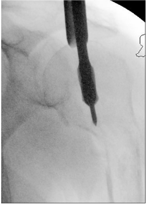 Fresa de alta velocidad que crea la v&iacute;a del canal medular desde el h&uacute;mero proximal al distal