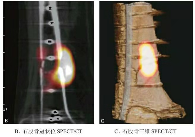 SPECT/CT representativo que muestra actividad metab&oacute;lica cerca del sitio de la fractura femoral