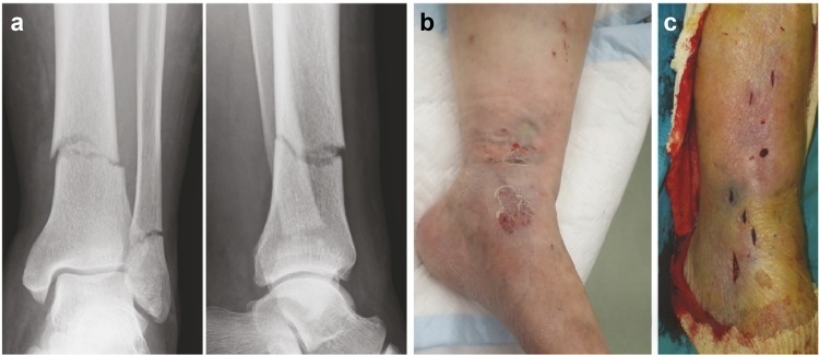 Fotograf&iacute;a cl&iacute;nica de traumatismo grave e hinchaz&oacute;n de tejidos blandos tras una lesi&oacute;n por aplastamiento de un veh&iacute;culo de motor en la tibia distal