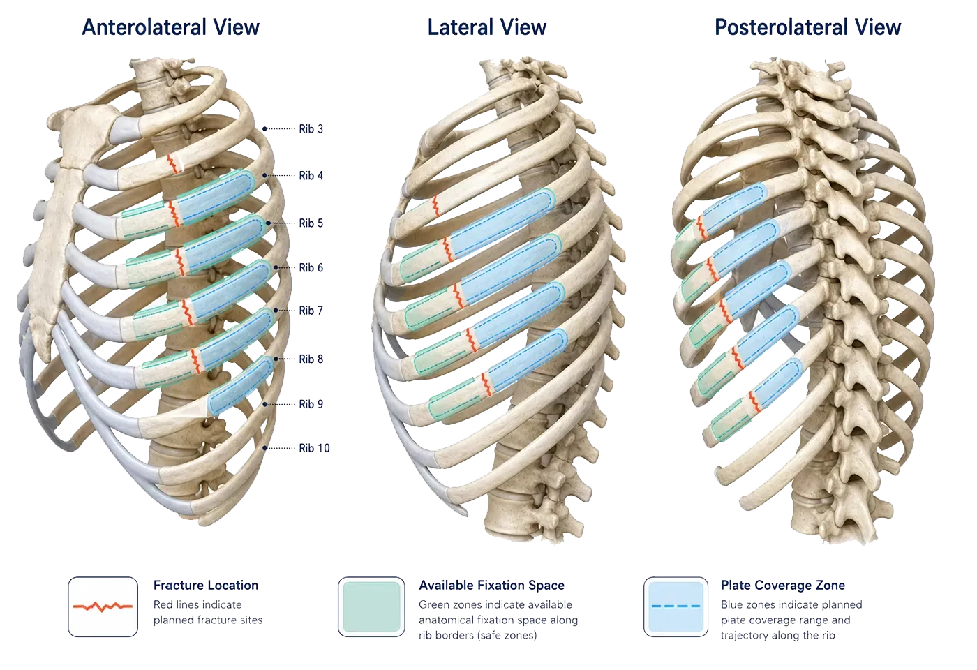 Rib fracture location and plate planning views