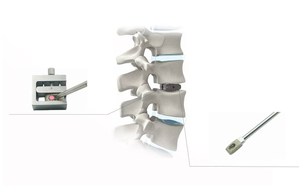 Modelo de columna y osteointegraci&oacute;n de jaula PLIF PEEK