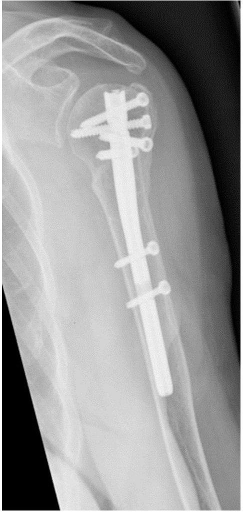 Radiograf&iacute;a anteroposterior de seguimiento de dos a&ntilde;os que muestra una curaci&oacute;n completa de la fractura y un hardware estable.