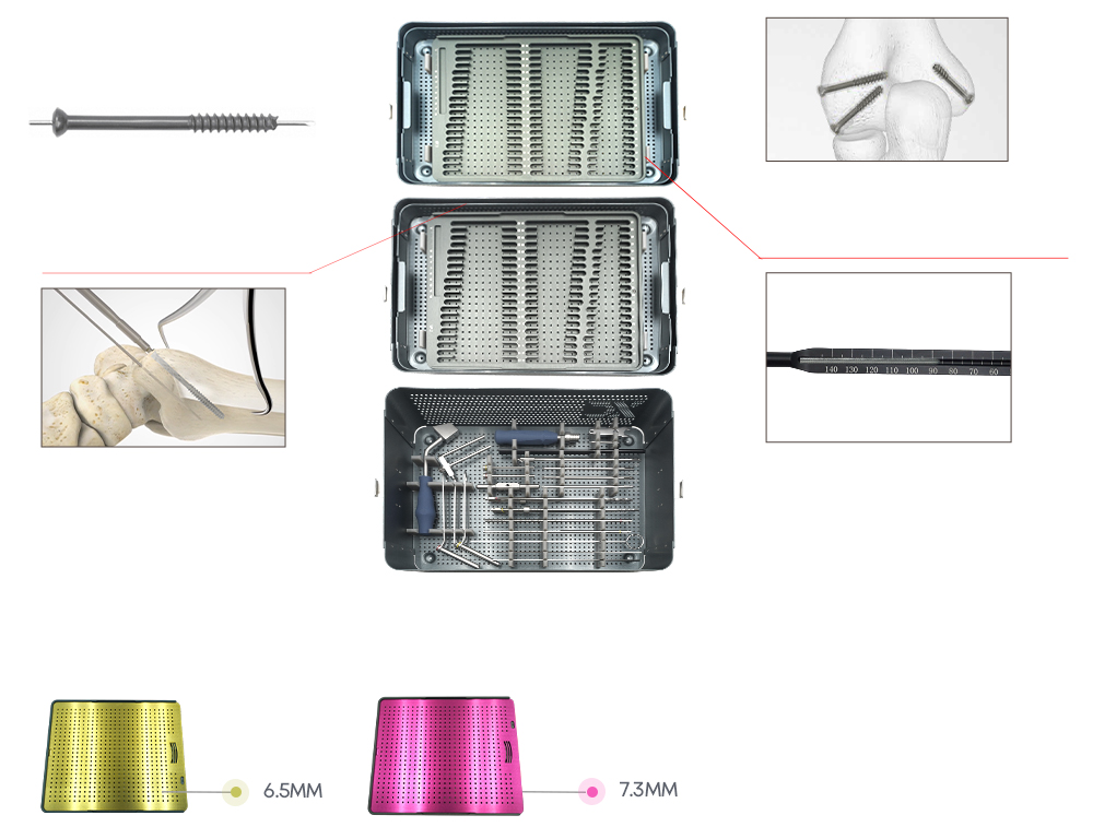 Fijaci&oacute;n por compresi&oacute;n y medici&oacute;n de profundidad con tornillos canulados 6.5/7.3