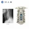Sistema de placa cervical anterior ultrafina de 0,8 mm