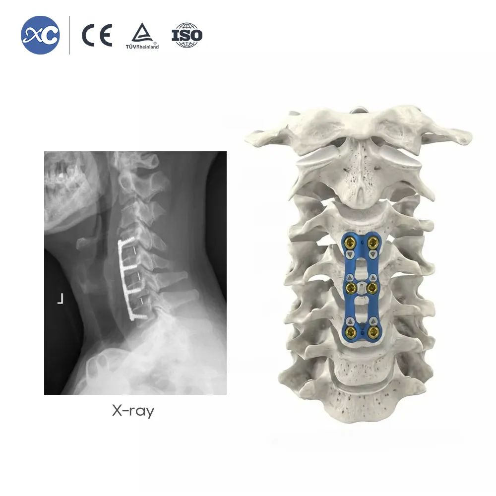 Sistema de placa cervical anterior ultrafina de 0,8 mm