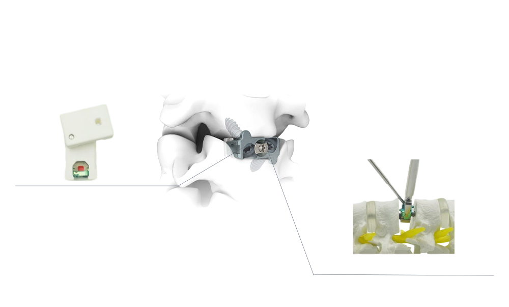Detalles del producto de la jaula cervical de PEEK de perfil cero con tornillos de bloqueo integrados