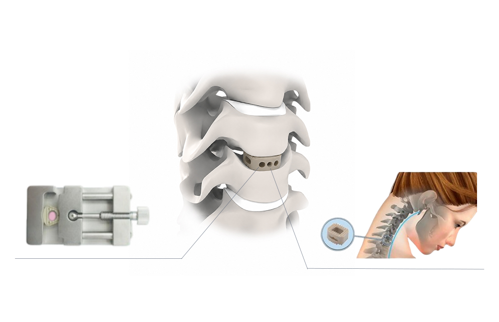 Biomec&aacute;nica cervical PEEK Cage II y ajuste de la anatom&iacute;a de la columna
