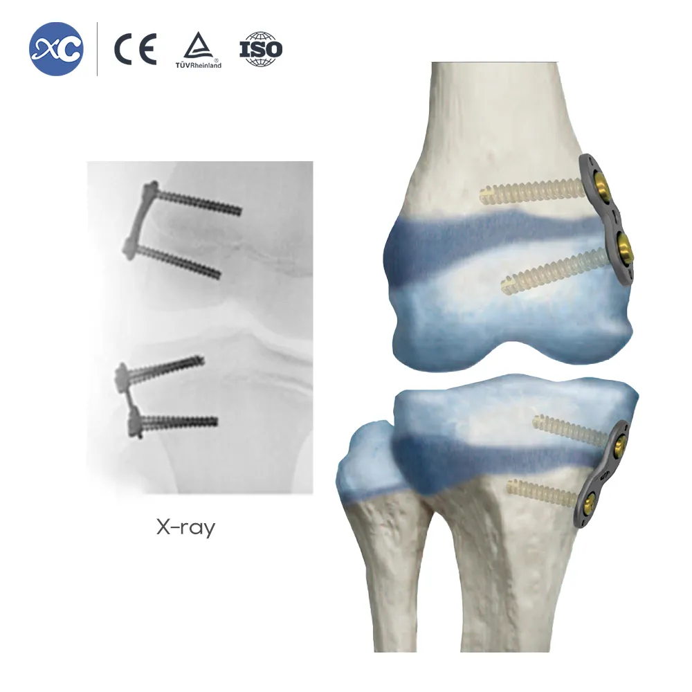 Conjunto de instrumentos ortopédicos pediátricos Valgus Varus