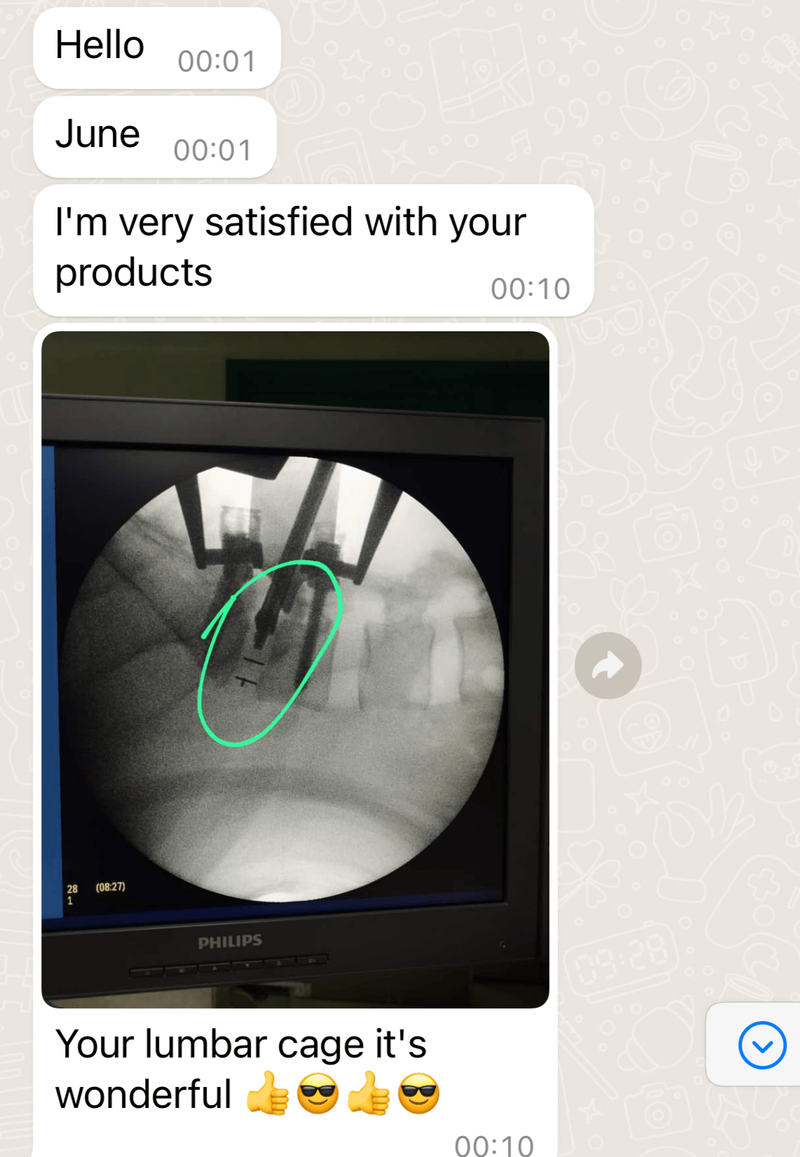 Imagen de fluoroscopia con brazo en C durante el procedimiento TLIF que muestra una visualizaci&oacute;n clara del marcador de tantalio en la caja intersom&aacute;tica lumbar