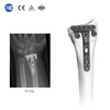 Placa de bloqueo multiaxial volar para radio distal (con terraja radial)