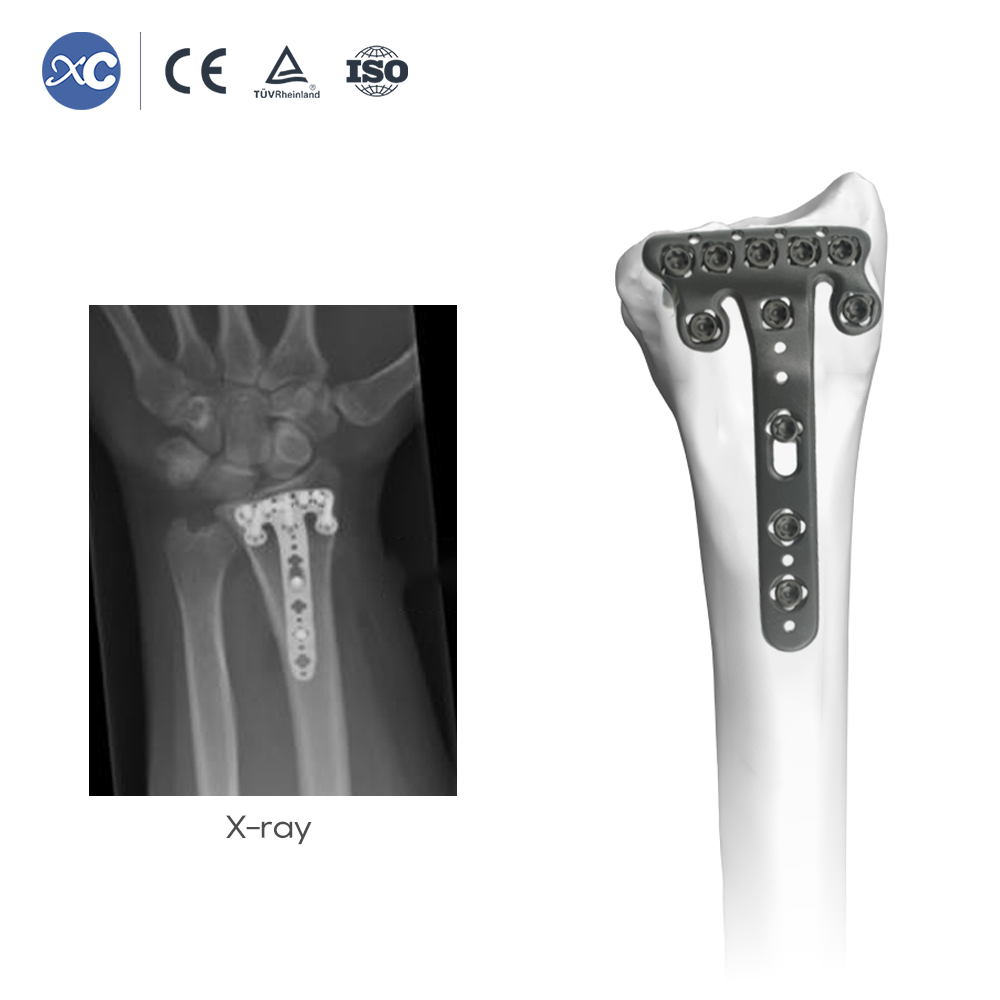 Placa de bloqueo multiaxial volar para radio distal (con terraja radial)