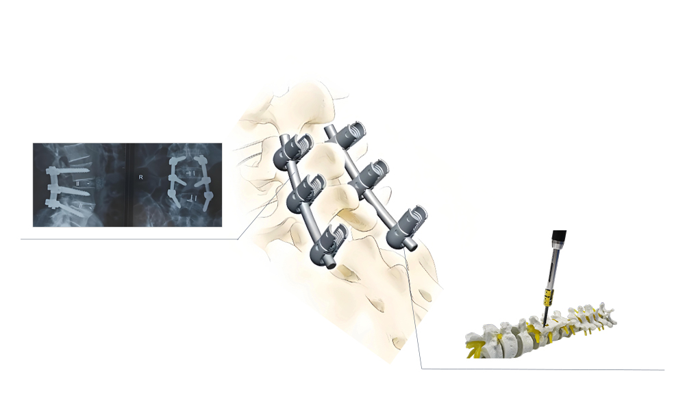 Sistema de tornillos pediculares espinales Estabilidad espinal tridimensional