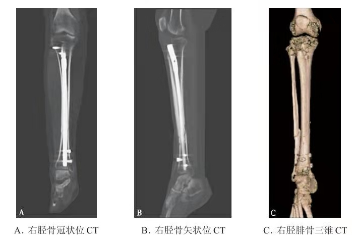 Radiograf&iacute;a representativa de fractura de tibia y peron&eacute; con fijaci&oacute;n con clavo intramedular