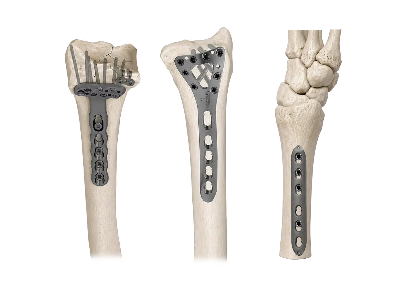 Volar, dorsal and column-specific distal radius plate positions
