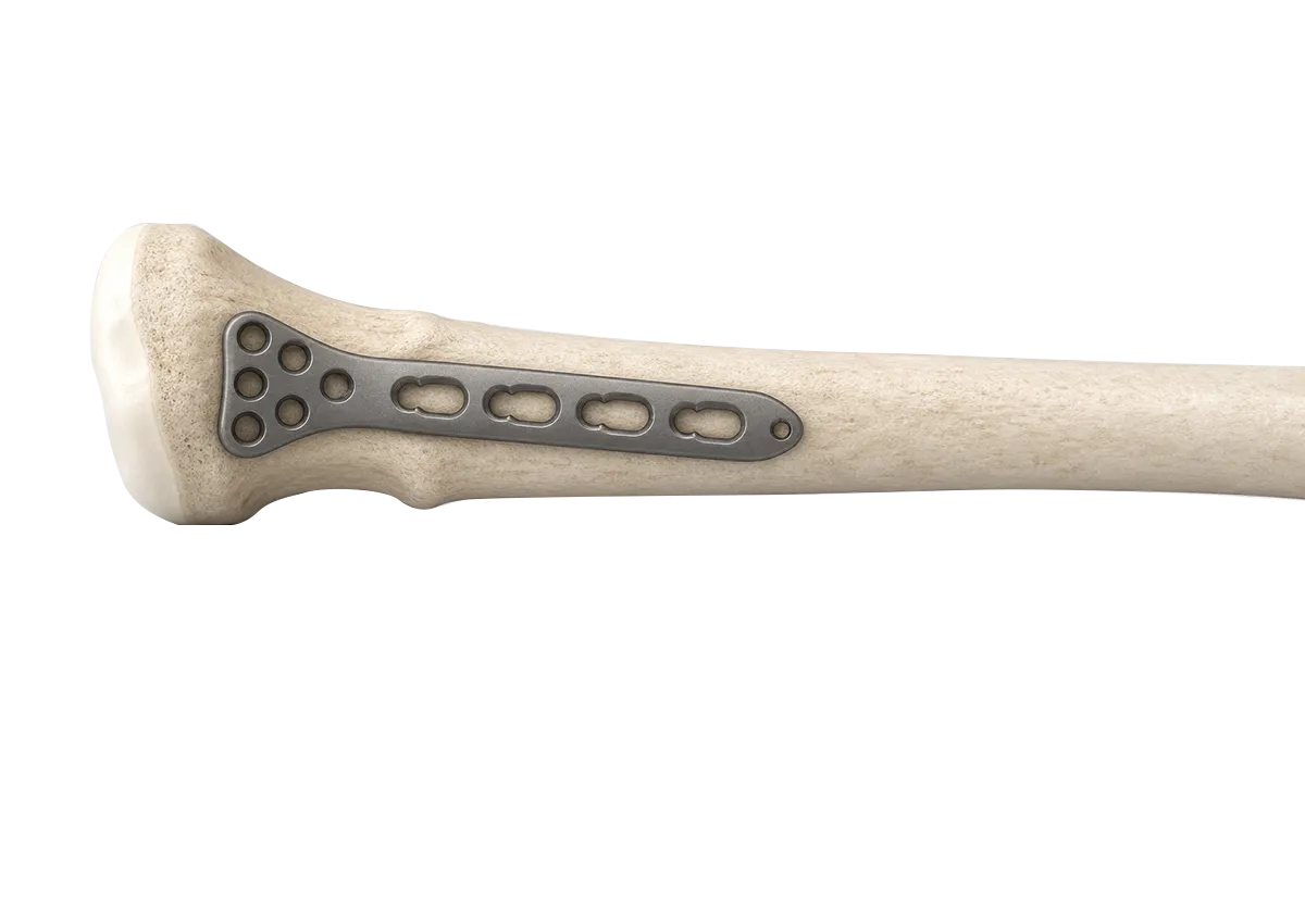 Lateral application of a radial head locking plate