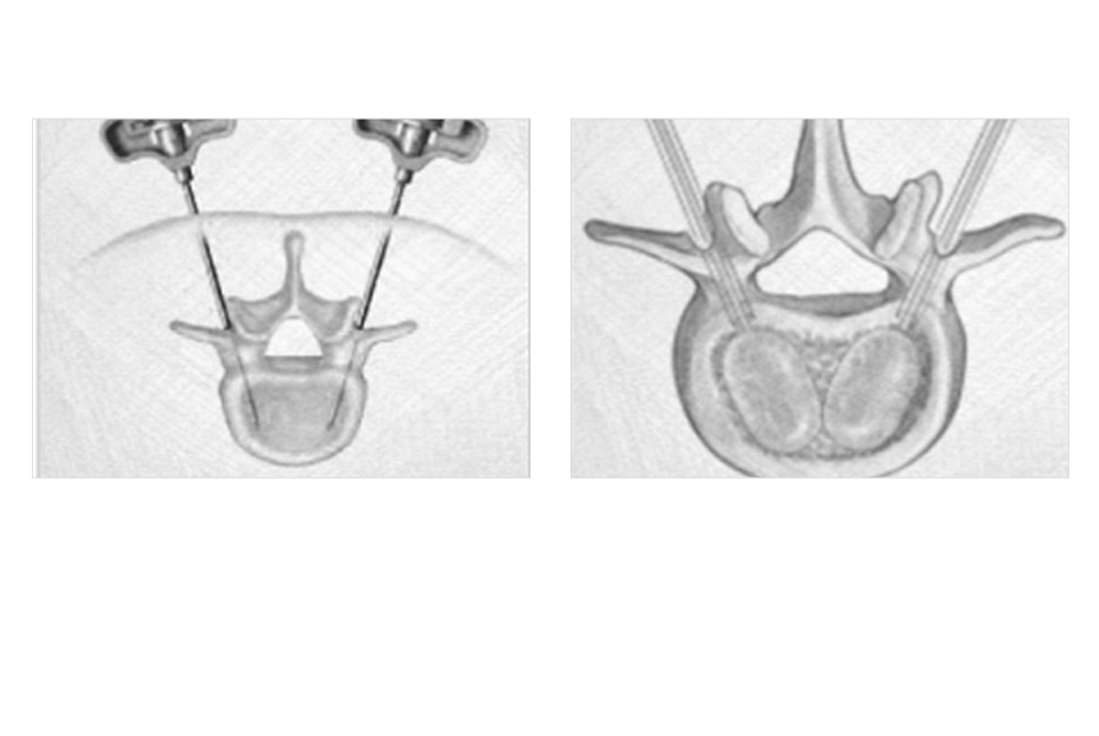 Indicaciones cl&iacute;nicas y especificaciones del bal&oacute;n de cuerpo vertebral para fracturas por compresi&oacute;n osteopor&oacute;ticas