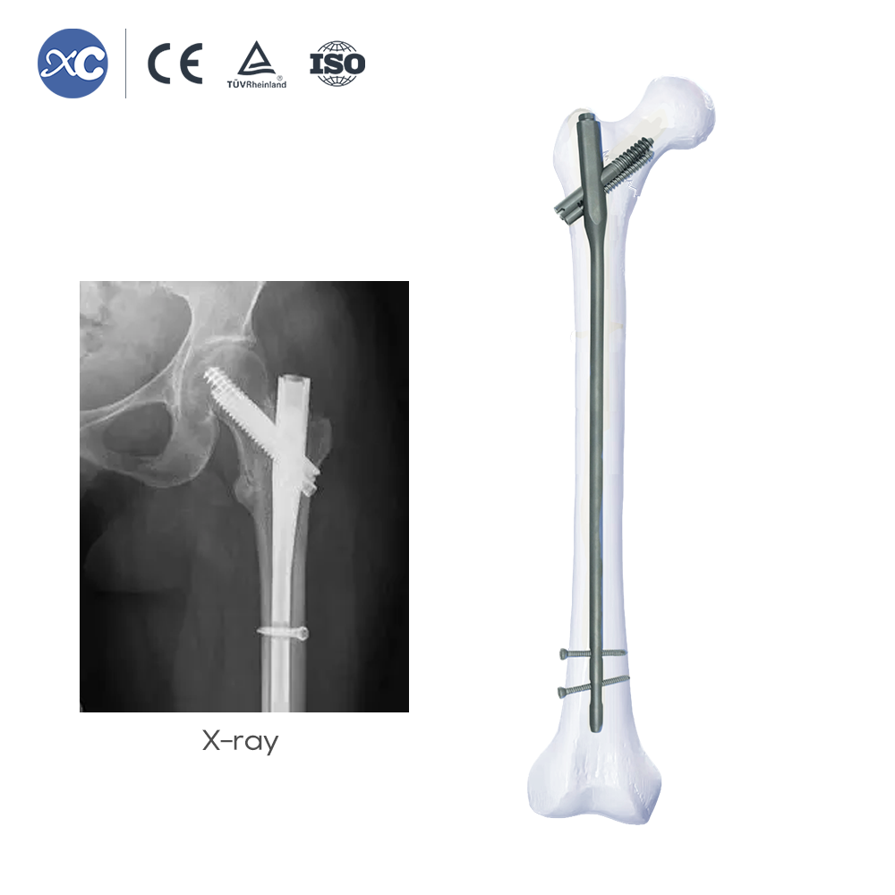 Sistema de clavo intramedular Intertan: fijación de fractura femoral proximal