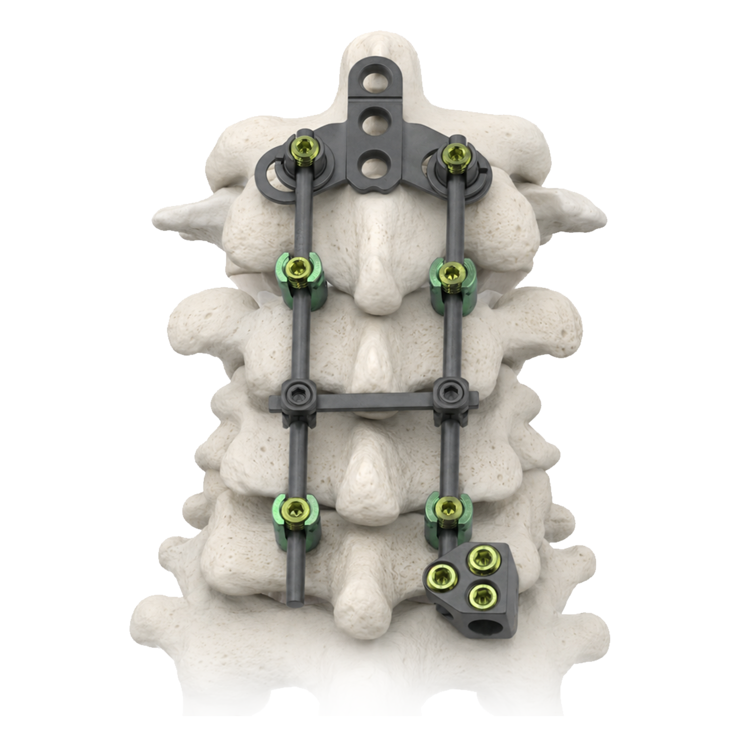 Posterior cervical screw rod fixation system