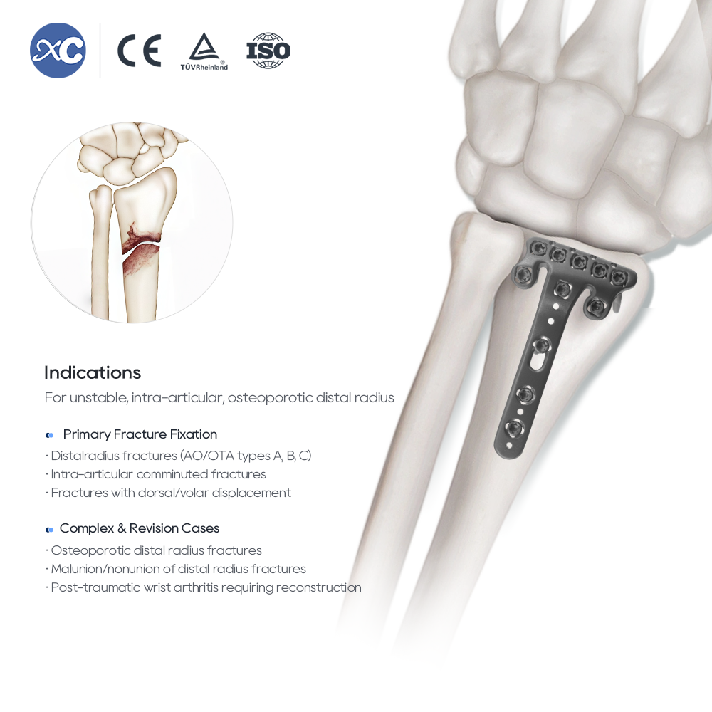 Placa de bloqueo multiaxial volar para radio distal (con terraja radial)