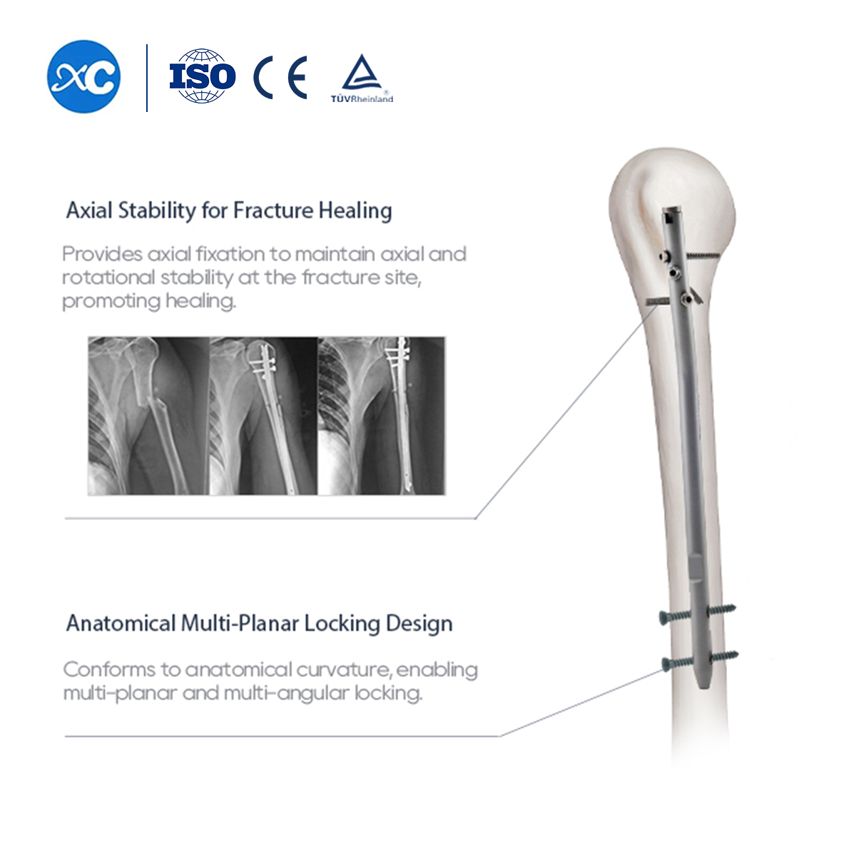 Clavo intramedular humeral