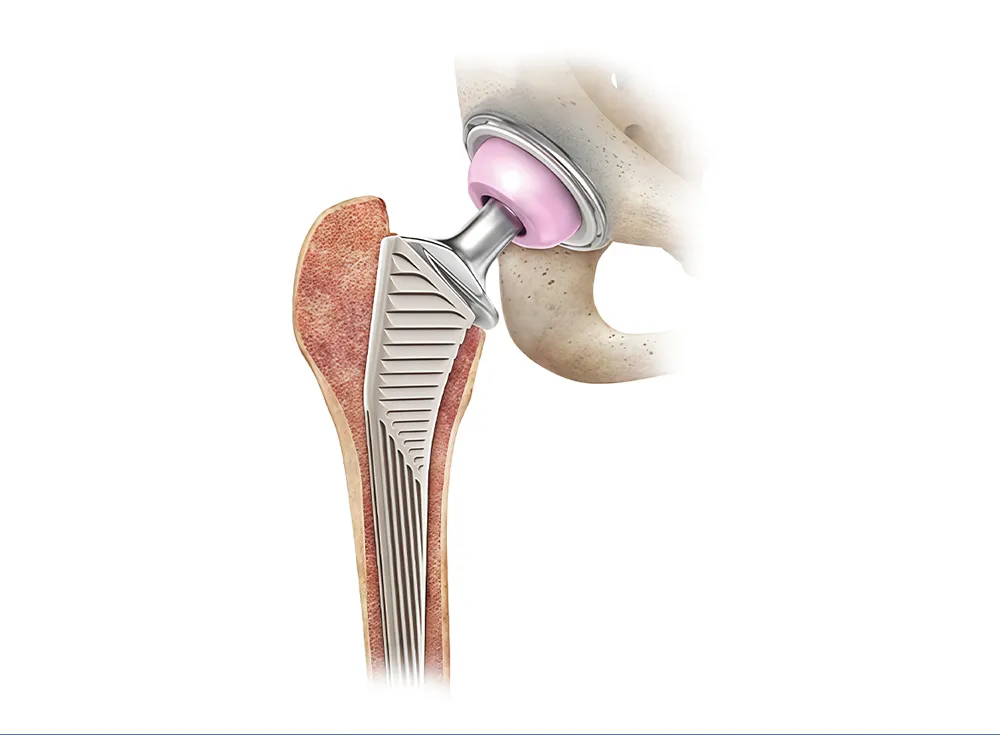 Pr&oacute;tesis de reemplazo total de cadera con v&aacute;stago femoral, cabeza femoral, revestimiento y copa acetabular en articulaci&oacute;n de cadera