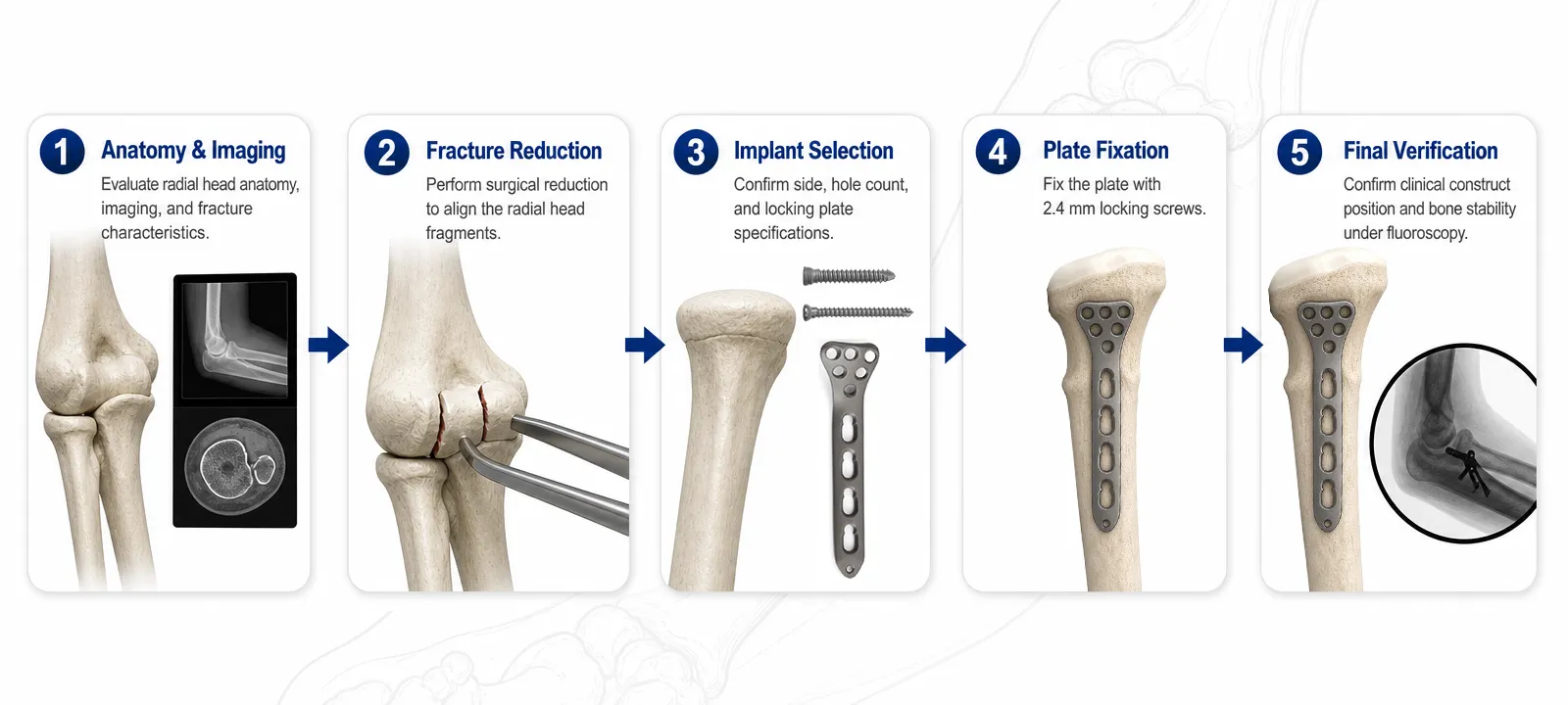 High-level radial head fixation workflow
