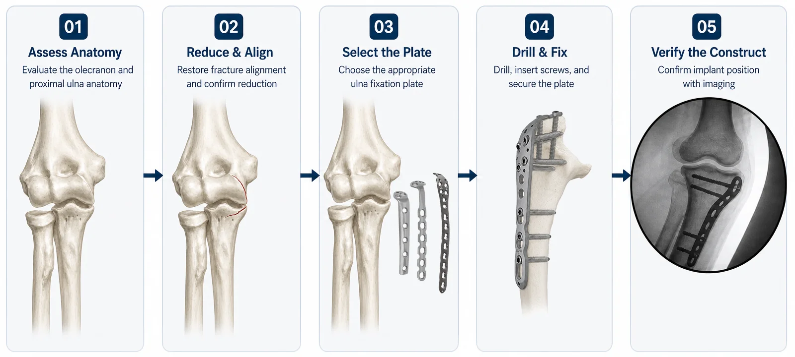 High-level olecranon and proximal ulna fixation workflow