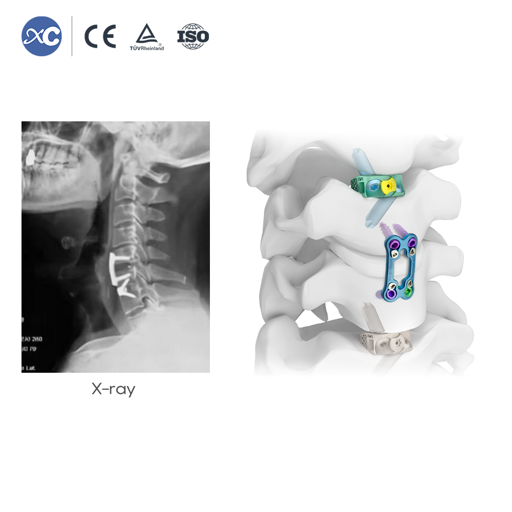 Juego de instrumentos para retractor cervical
