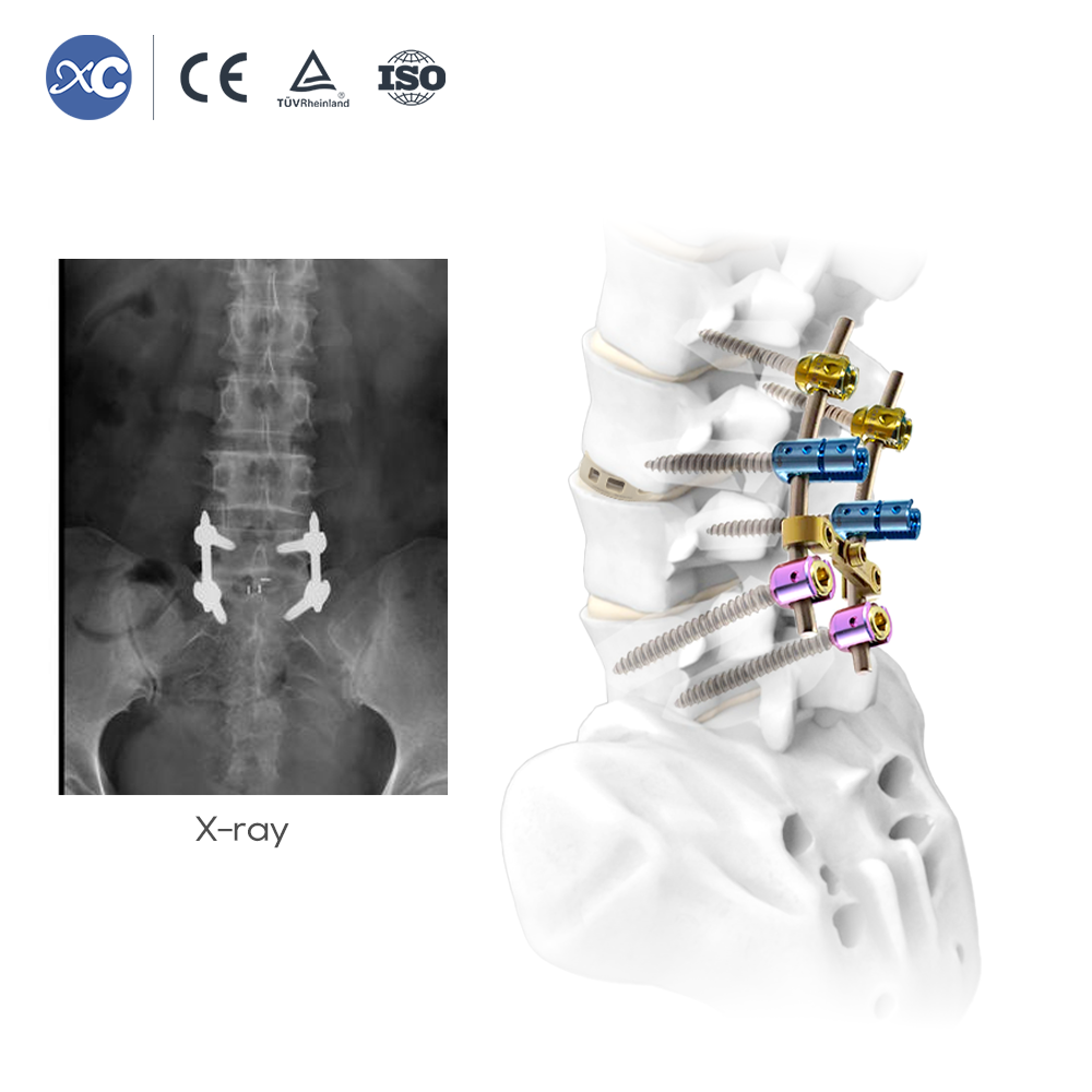 Conjunto de instrumentos para cirugía de columna UBE