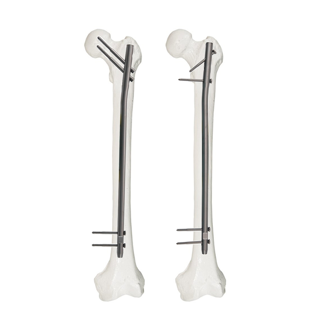 Nuevo clavo intramedular para reconstrucción femoral
