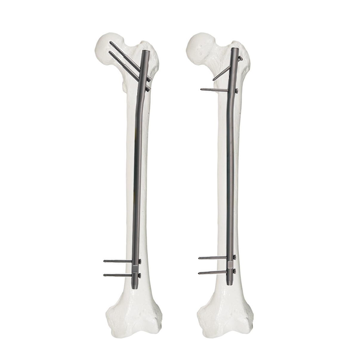 Nuevo clavo intramedular para reconstrucción femoral