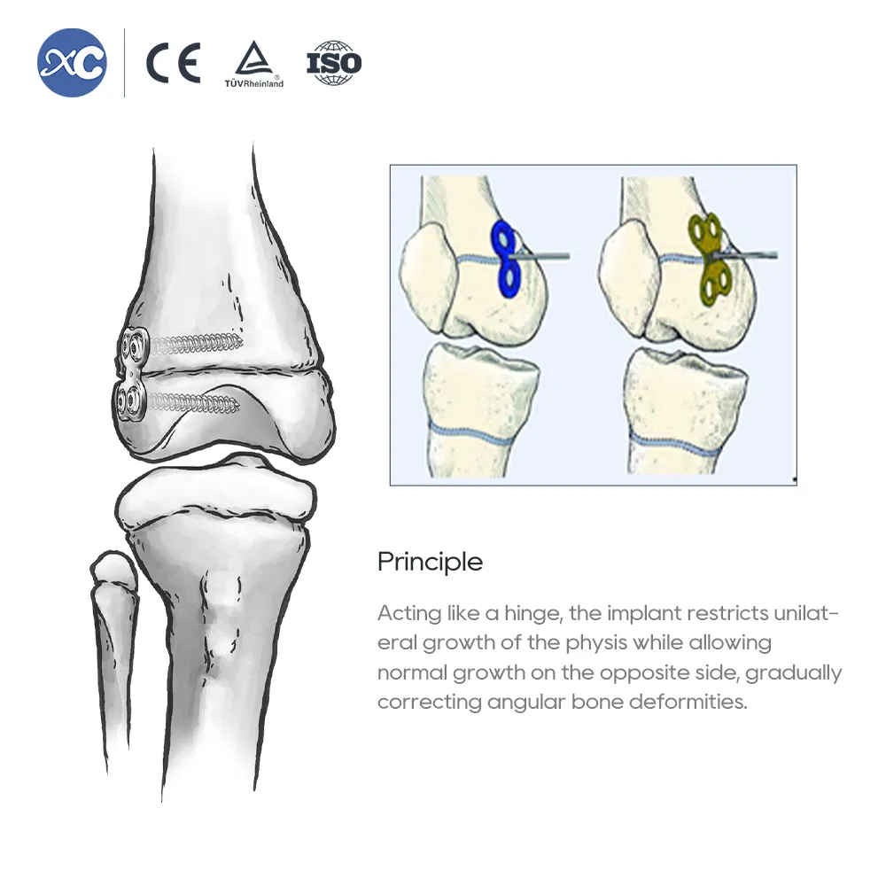 Conjunto de instrumentos ortopédicos pediátricos Valgus Varus
