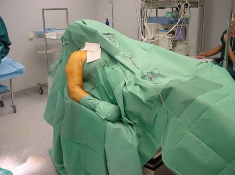Paciente en posici&oacute;n de silla de playa con la extremidad superior izquierda apoyada para cirug&iacute;a de fractura de h&uacute;mero proximal