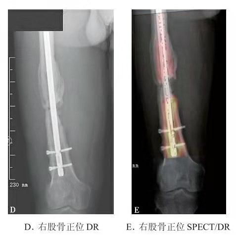 SPECT/CT representativa que muestra actividad limitada del trazador a lo largo de la l&iacute;nea de fractura femoral