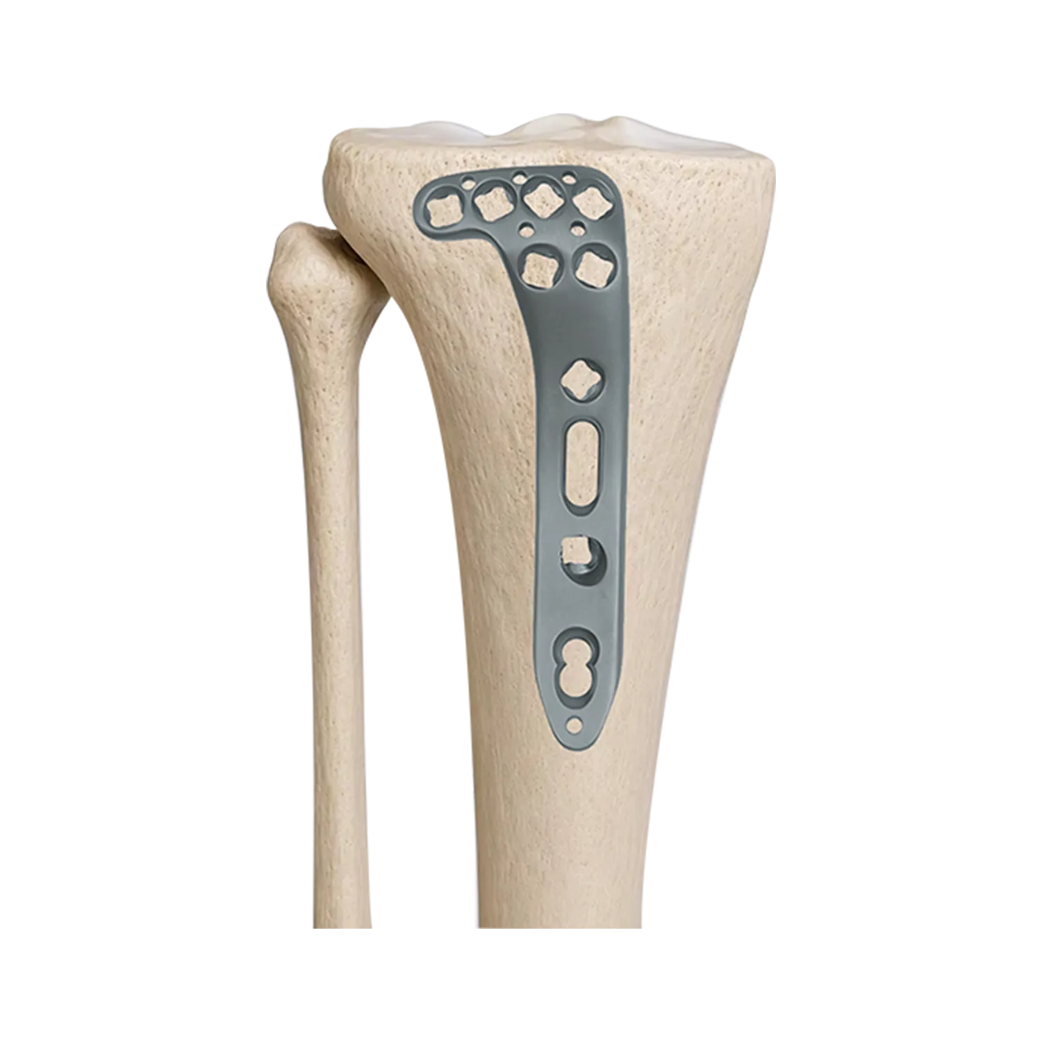 Placa de bloqueo de meseta tibial multiaxial fijada en el modelo de hueso de tibia proximal lateral