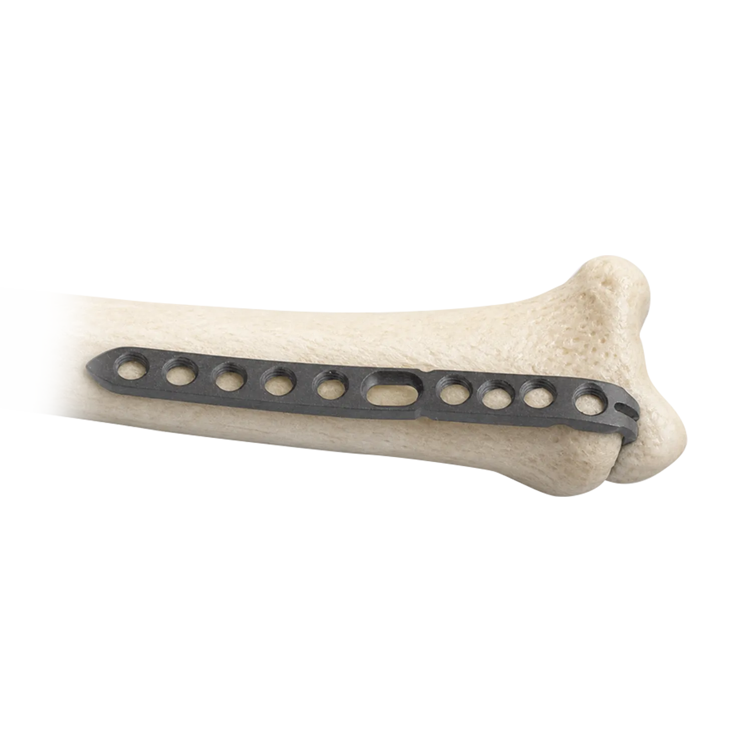 Placa de bloqueo estiloides cubital fijada en un modelo de hueso del c&uacute;bito distal
