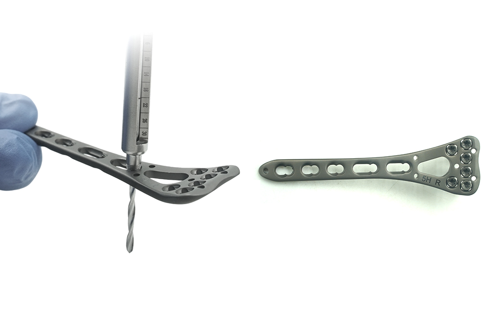 Aleaci&oacute;n de titanio premium y mecanizado CNC para implantes de radio ortop&eacute;dicos