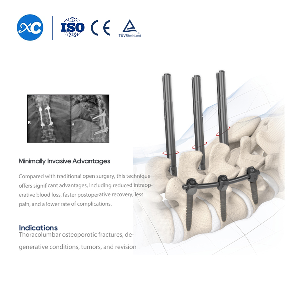 5.5 Tornillo pedicular Il para sistema espinal MIS