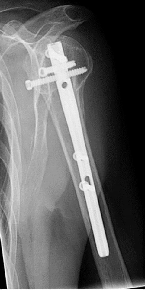 Radiograf&iacute;a lateral al a&ntilde;o que confirma la alineaci&oacute;n anat&oacute;mica y la curaci&oacute;n completa de la fractura.
