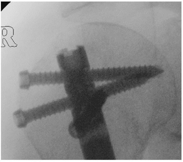 Radiograf&iacute;a posoperatoria que muestra la colocaci&oacute;n perfecta del clavo intramedular con tornillos de bloqueo proximales asentados en el hueso subcondral