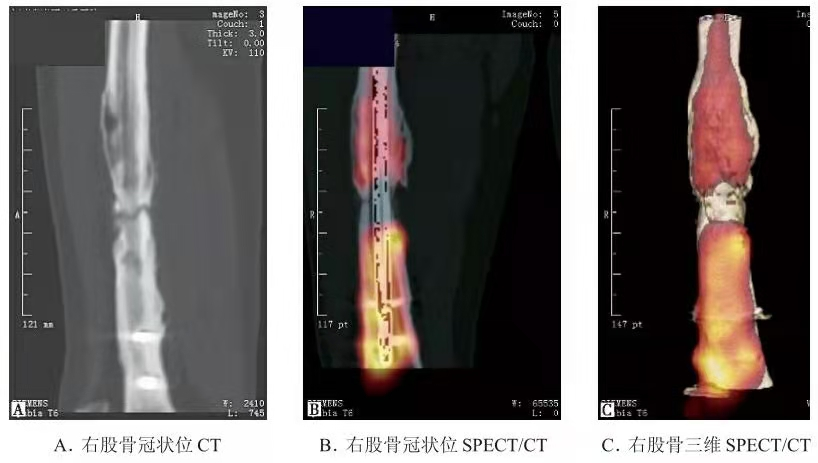 Radiograf&iacute;a representativa de fractura femoral con clavo intramedular y callo limitado.